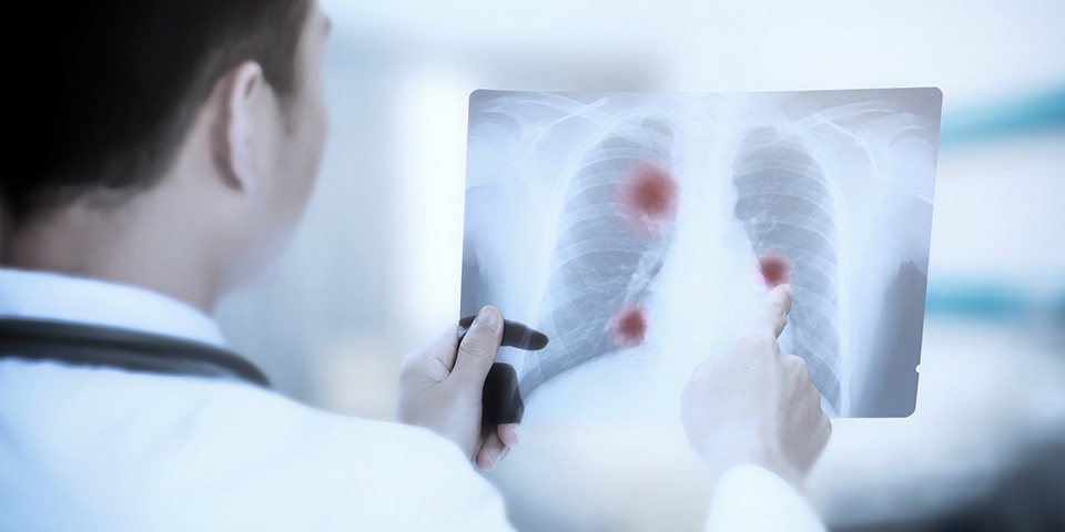 The total number of patients with pulmonary nodules in the country exceeds 100 million, and the inab